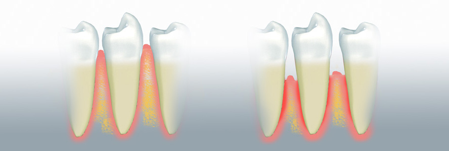 Ursache für eine Parodontitis sind Bakterien, die sich zwischen Zahn und Zahnfleisch ansammeln. 